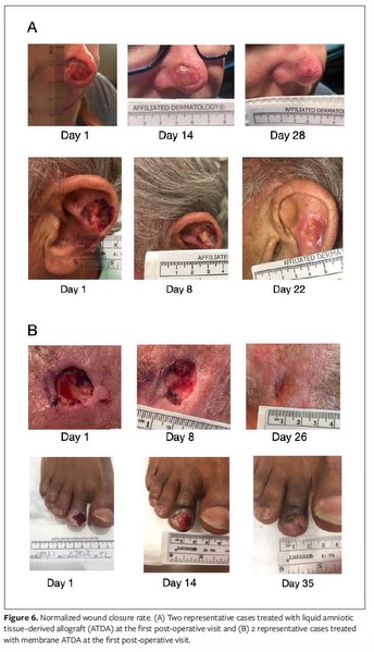 All Chronic Wound Conditions